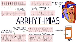 Understanding Arrhythmias [upl. by Aynotal926]