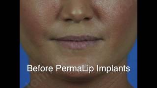 Permalip Implants [upl. by Dleifniw]