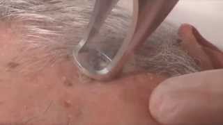 Queratosis seborreicas  Tratamiento con Lotus II 15071 [upl. by Wrench404]