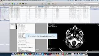 How to Use OsiriX [upl. by Horgan675]