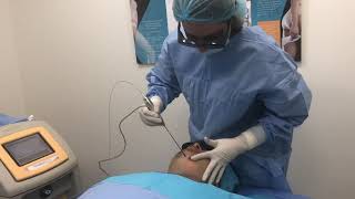 Liposuccion du double menton au laser par DR NEDRA GHARBI [upl. by Vernice]