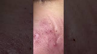 Big Cystic Acne Blackheads Extraction Blackheads amp Milia Whiteheads Removal Pimple Popping shorts [upl. by Harneen284]