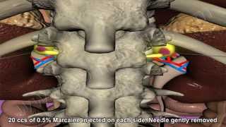 Celiac Plexus Block [upl. by Habeh]