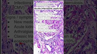 Acute interstitial nephritis [upl. by Whiffen]