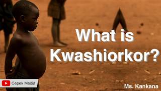 What is Kwashiorkor disease  Medical Science  General Medicine [upl. by Nelda]