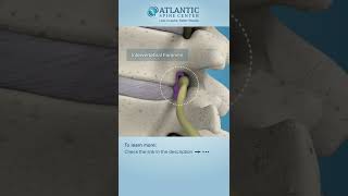 Lumbar Lateral Stenosis Shorts ​Atlantic Spine Center [upl. by Hcire]