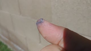 Healing Process of my Sliced Thumb Slideshow [upl. by Lyns]