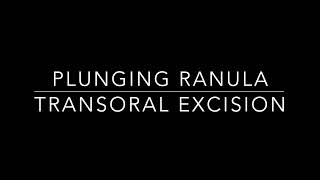 Plunging ranula surgery [upl. by Arno142]