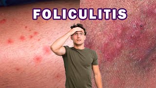 CÓMO ELIMINAR LA FOLICULITIS INFECCIOSA  BACTERIANA [upl. by Eiffe]