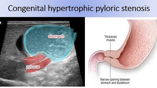 Pyloric stenosis step by step pylorus ultrasound Pyloric hypertrophic [upl. by Dustin66]