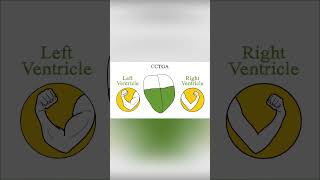 Congenitally corrected transposition of the great arteries CCTGA [upl. by Frech87]