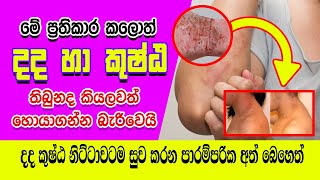 දද කුෂ්ඨ සදහා පාරම්පරික හෙළ සත්කාර  Treatments for Eczema sinhala [upl. by Eimot900]