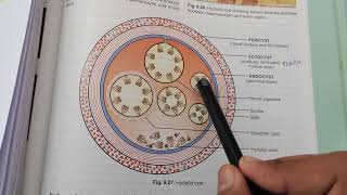 Hydatid Cyst amp Casoni Test [upl. by Windzer]