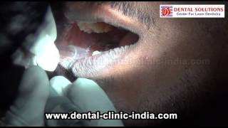 Lichen Planus Laser Removal India  Mouth Rashes Treatment Bangalore [upl. by Zebapda]