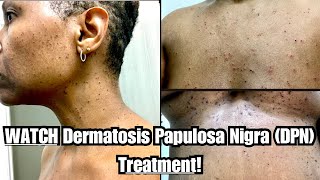 Dermatosis Papulosa Nigra DPN Removal 😵😀 QuestionAnswer [upl. by Linc875]