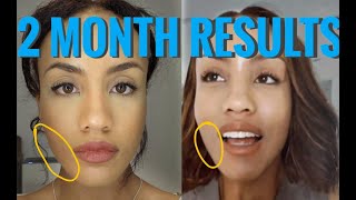 Buccal Fat Removal  Answering your questions  Regrets  Complications  2 Month Update [upl. by Ocimad]