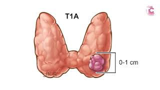 Thyroid Cancer what is my prognosis [upl. by Rehpotsirc]