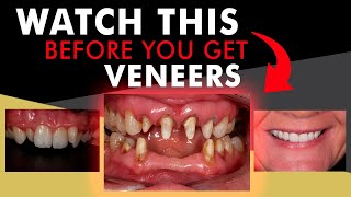 BEFORE Getting Veneers  Essential facts you need to know [upl. by Yllah412]