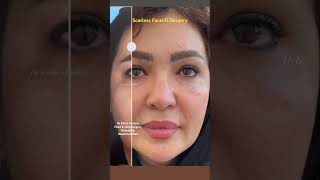 Amazing transformation  scarless Facelift Surgery  Dr Zahra Karbasi لیفت صورت بدون اسکارپوستی [upl. by Adnaram14]