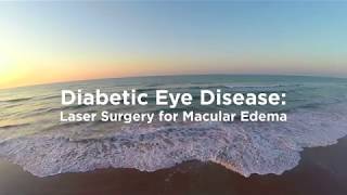 Diabetic Macular Edema Treatment  Laser [upl. by Nylle309]