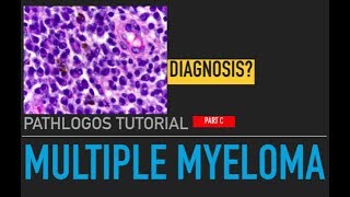 Multiple myeloma Pathology amp Diagnosis [upl. by Tiphani]