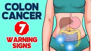 7 Warning Signs of Colon Cancer in 2024 [upl. by Anrak]