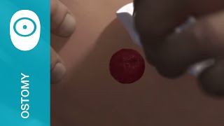 Removing a 1piece urostomy pouch [upl. by Yelah]