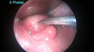 Retropharyngeal Abscess [upl. by Yvon]