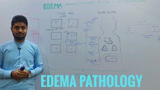 EdemaOedemaEdema pathologyintroduction to edema [upl. by Adel]