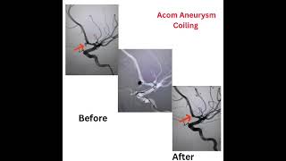 Aneurysm coiling by suresh giragani [upl. by Aspia]