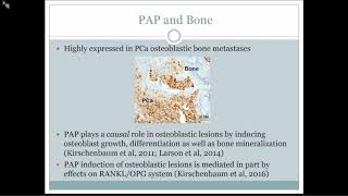 Prostate Cancer Osteoblastic Bone Metastases [upl. by Hnilym]