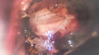 Brain stem hemorrhage by Subtemporal transtentorial approach [upl. by Ataeb770]