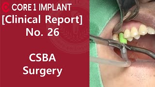 CYBERMED Clinical Report 16 Crestal sinus bone augmentation [upl. by Anikas]