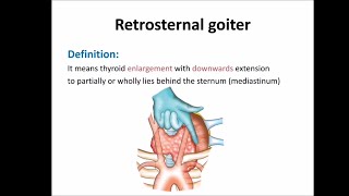 Retrosternal goiter [upl. by Luhar]