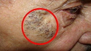 Senile Comedones Pimples Popping amp Blackhead Removal Tools 👍👍👍 [upl. by Nodal]