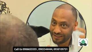 Yigerem Dejene one year hair transplant result Marcia Surgical Center [upl. by Shelli]