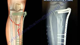 External Fixation With Locking Plate  Everything You Need To Know  Dr Nabil Ebraheim [upl. by Assennav]