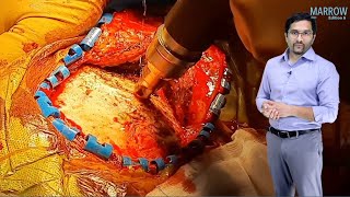 E6 Sample Video Epidural amp Subdural Hematoma Surgery [upl. by Iznik718]