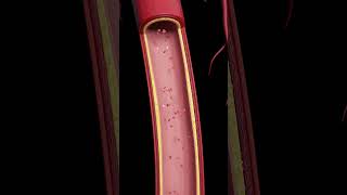 Atherosclerosis The Silent BuildUp [upl. by Laurentium]