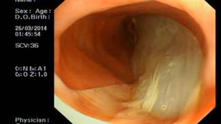 Bullous Pemphigoid Patient With the Unusual Complication  Sloughing Esophageal Mucosa [upl. by Conn]