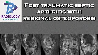 Post traumatic septic arthritis with regional osteoporosis [upl. by Xavier]