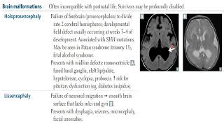 USMLE STEP 1  Neurology  Neural defects Brain malformation [upl. by Esaertal]