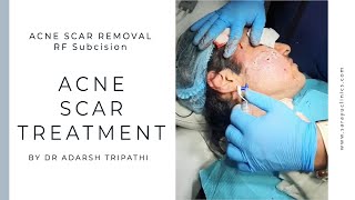 💉 Treatments for ACNE SCARS ✔️  Dr Adarsh Tripathi [upl. by Esinwahs]