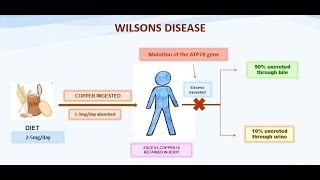 Wilsons disease By DrVShanthi [upl. by Nesyaj]