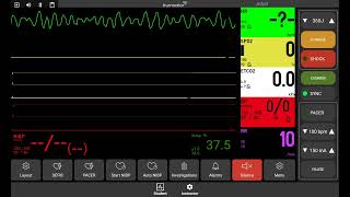 Ventricular Fibrillation [upl. by Hepzi]