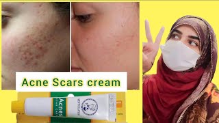 Review Of Acnes Scar Care Gel  How To Use  Medicated Acne Scar Treatment [upl. by Irama]