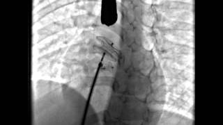 Septal Occluder release across the ASD [upl. by Gipsy189]