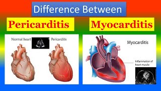 Difference between Pericarditis and Myocarditis [upl. by Mattland364]