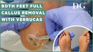 Callus removal from feet both feet and three verruca plantar warts treatment [upl. by Leamiba]