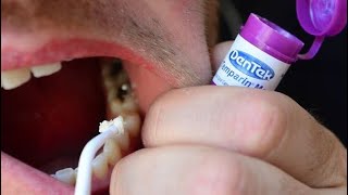 How To Fix a Broken Tooth with Dentemp or DenTek Tooth Filling and Crown Repair [upl. by Aryamo]